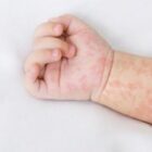 Ilustrasi penyakit campak (Istimewa)